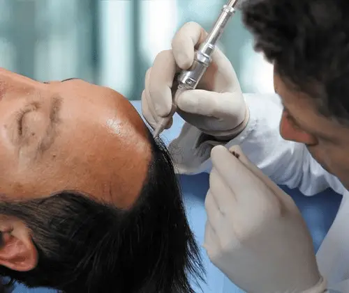 Surgery for big forehead