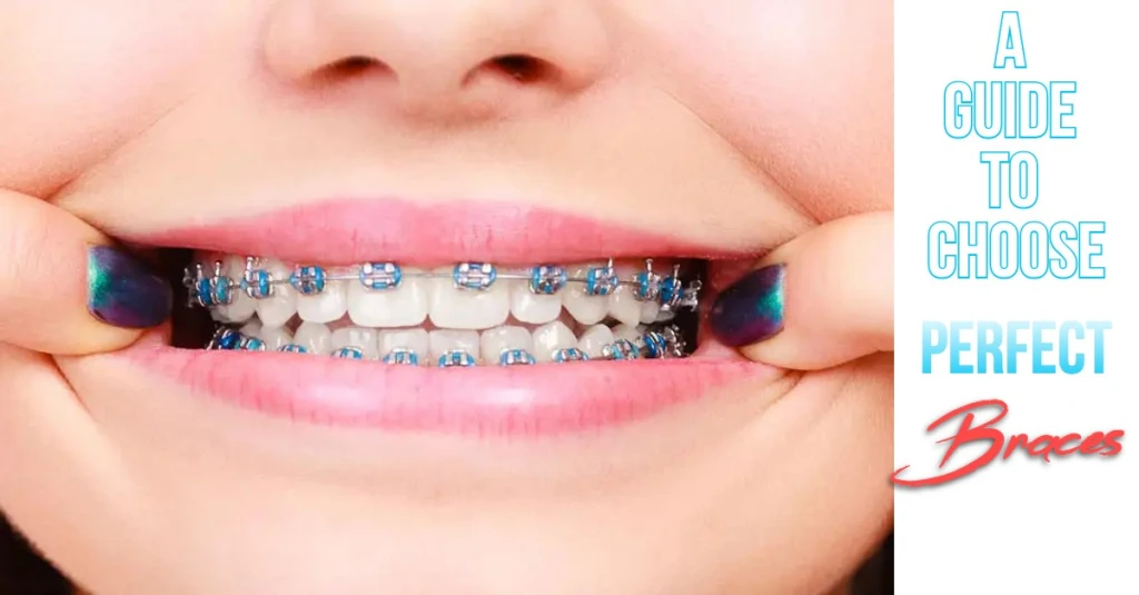 A Guide To Choose Perfect Braces